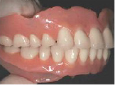 BPS完成義歯
